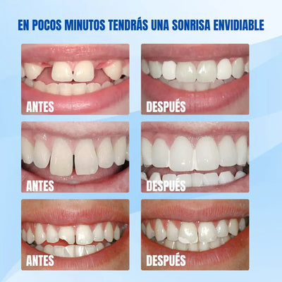Resina Dental Moldeable: Sonrie Sin Miedo 💫